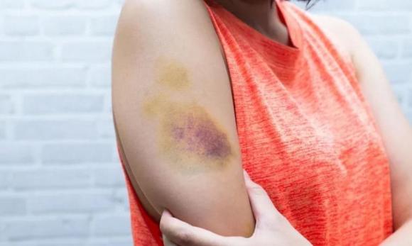 vết thâm, bầm tím, cách chữa vết thâm, sức khỏe , sức khỏe phụ nữ