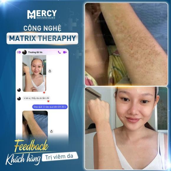 Phòng khám Mercy Việt Nam, trị viêm nang lông, Matrix Theraphy
