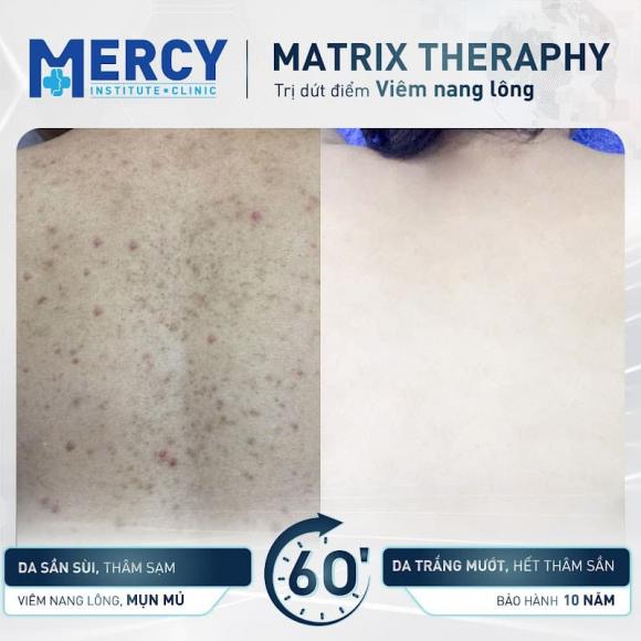 Phòng khám Mercy Việt Nam, trị viêm nang lông, Matrix Theraphy