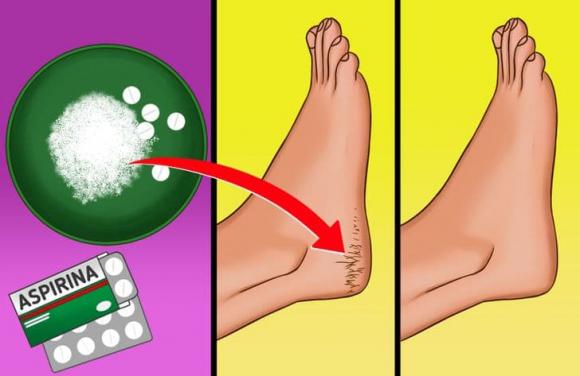 nứt gót chân, cách điều trị nứt gót chân, khỏe đẹp 