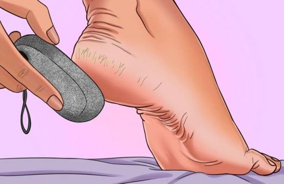nứt gót chân, cách điều trị nứt gót chân, khỏe đẹp 