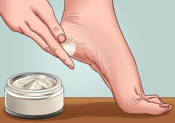 nứt gót chân, cách điều trị nứt gót chân, khỏe đẹp 