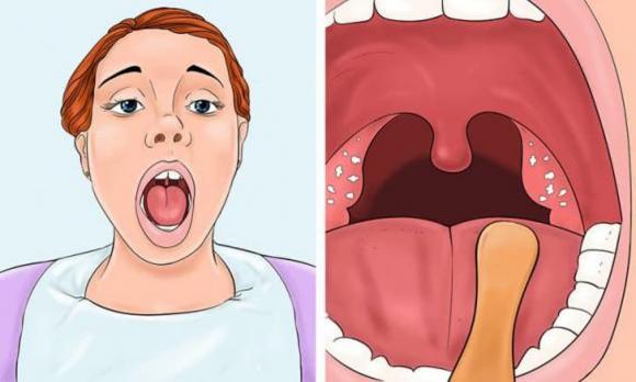 viêm họng, cách điều trị viêm họng, món ăn trị viêm họng