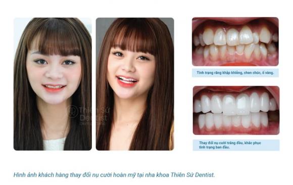 Nha khoa Thiên Sứ Dentist, Chăm sóc răng miệng, Răng sứ thẩm mỹ