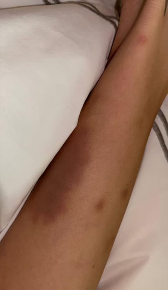 Bella Hadid, Bella Hadid chấn thương, sao Hollywood