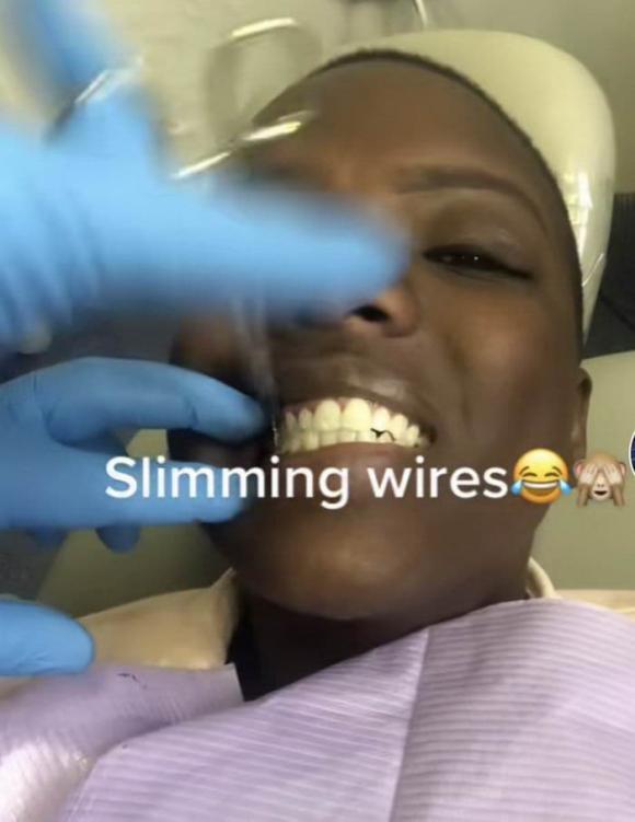 khóa răng, giảm cân, ép cân, 'Slimming Wires
