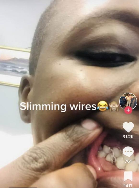 khóa răng, giảm cân, ép cân, 'Slimming Wires