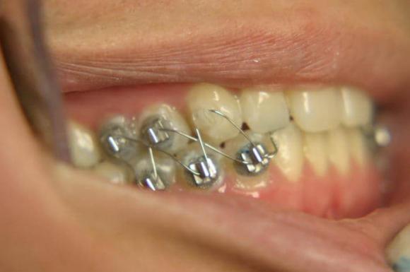 khóa răng, giảm cân, ép cân, 'Slimming Wires