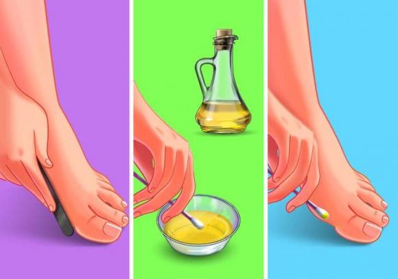 loại bỏ mụn cóc, mụn cóc, mẹo trị mụn