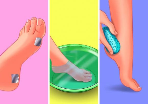 loại bỏ mụn cóc, mụn cóc, mẹo trị mụn