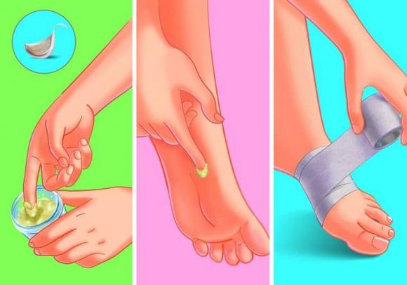 loại bỏ mụn cóc, mụn cóc, mẹo trị mụn
