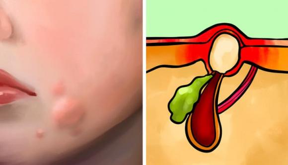 trị mụn, trị sẹo, chăm sóc da