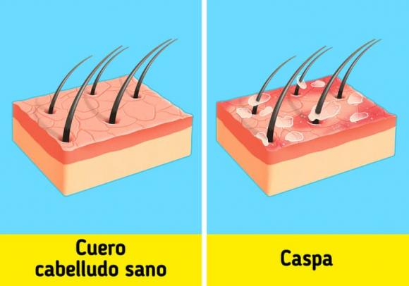 bị gàu, cách thoát khỏi gàu, tóc đẹp 