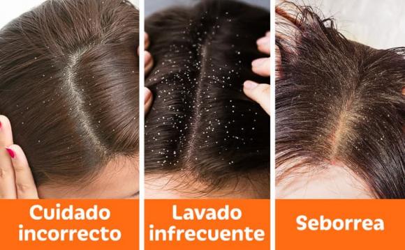 bị gàu, cách thoát khỏi gàu, tóc đẹp 