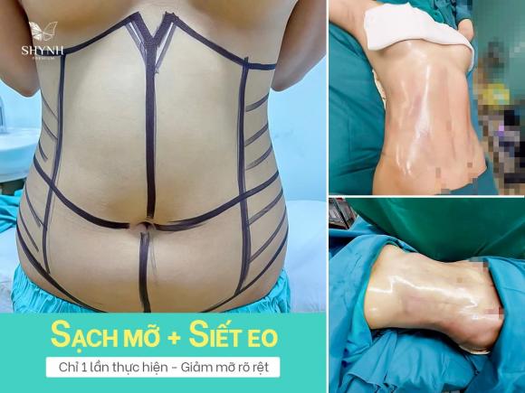 hut-mo-siet-eo-182 (1).jpg 0 Hút Mỡ Siết Eo, Công nghệ Body Jet, Phòng Khám Phẫu Thuật Thẩm Mỹ Shynh Premium