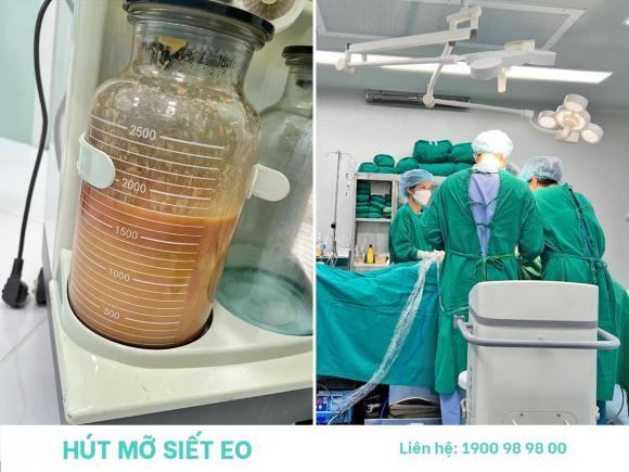 hut-mo-siet-eo-182 (1).jpg 0 Hút Mỡ Siết Eo, Công nghệ Body Jet, Phòng Khám Phẫu Thuật Thẩm Mỹ Shynh Premium