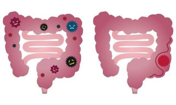 polyp, ung thư, đại tràng