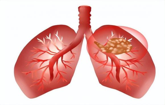bệnh phổi, nốt phổi, hoa quả tốt cho phổi