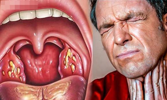 viêm họng, cách điều trị viêm họng, món ăn trị viêm họng