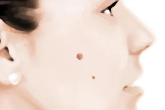 khối u ác tính, nốt ruồi, trong da nốt ruồi hỗn hợp, Phẫu thuật tẩy nốt ruồi