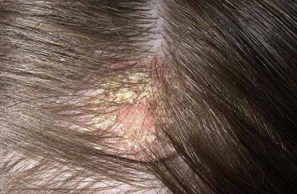 vảy da đầu, bụi trắng trên da đầu, chăm sóc da đầu
