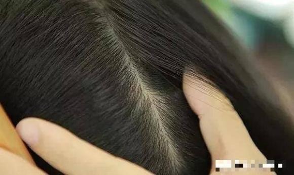 vảy da đầu, bụi trắng trên da đầu, chăm sóc da đầu