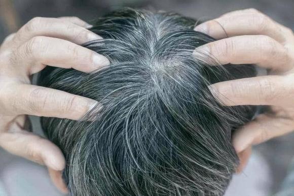vảy da đầu, bụi trắng trên da đầu, chăm sóc da đầu
