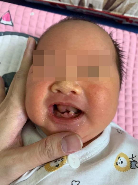 mới sinh đã có răng, trẻ sơ sinh, trẻ mọc răng,