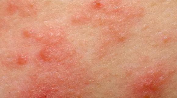 cổ tử cung, virus hpv, ngứa vùng kín