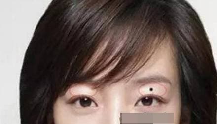 nốt ruồi, vị trí nốt ruồi