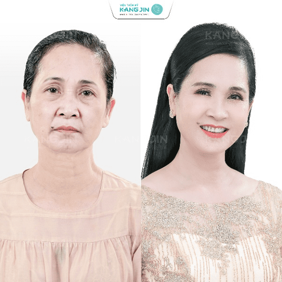 sao làm đẹp, trẻ hóa da mặt, KangJin