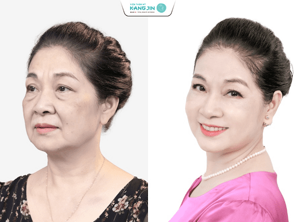 sao làm đẹp, trẻ hóa da mặt, KangJin