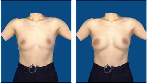 cong-nghe-Vectra-XT-3D.jpg 0 công nghệ Vectra XT 3D, Vectra XT 3D, làm đẹp