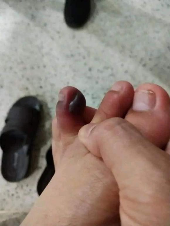 cuốn chiếu, con cuốn chiếu, chất độc của cuốn chiếu