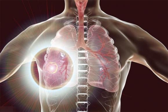 Ung thư phổi, dấu hiệu ung thư phổi
