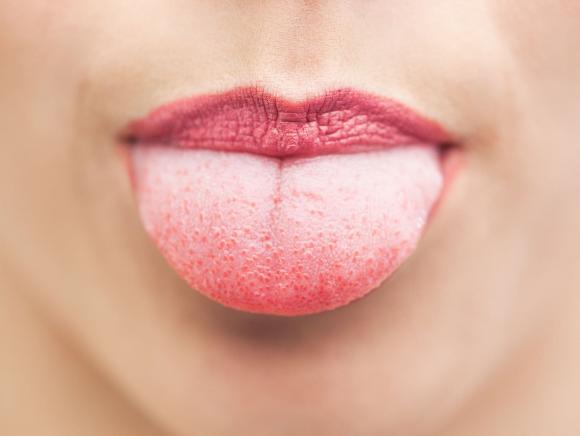 Bỏng lưỡi khi ăn đồ nóng, áp dụng ngay 1 trong 10 cách này giúp thuyên giảm nhanh chóng