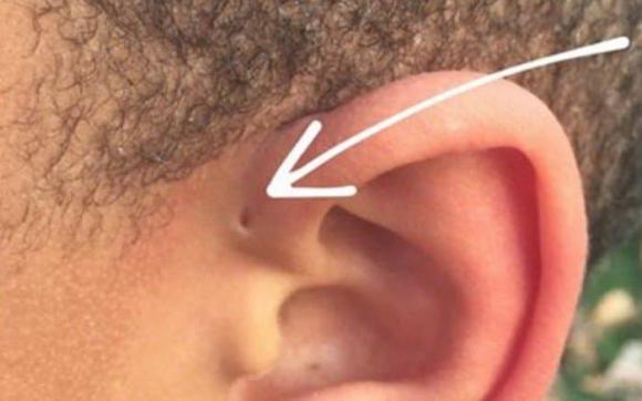 Cạnh ống tai có một cái lỗ nhỏ, cái lỗ đó là gì? Tính năng này có bất thường không?