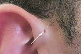 Có một lỗ nhỏ bên cạnh ống tai, đó là lỗ gì? Đặc điểm này liệu có bất thường?