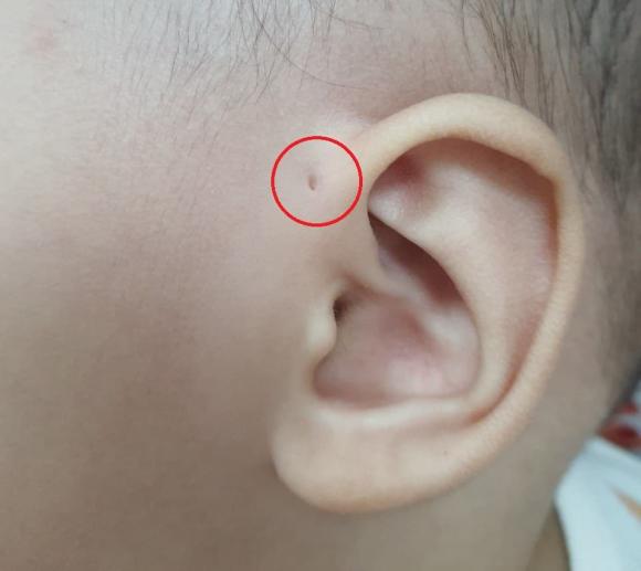 Có một lỗ nhỏ bên cạnh ống tai, đó là lỗ gì? Đặc điểm này liệu có bất thường?