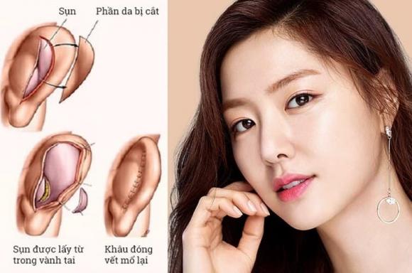 nang-mui-bang-sun-tai-la-gi-1.jpg 0 Nâng mũi bằng sụn tai, Seoul Center