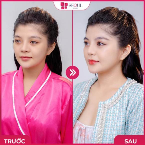 nang-mui-bang-sun-tai-la-gi-1.jpg 0 Nâng mũi bằng sụn tai, Seoul Center