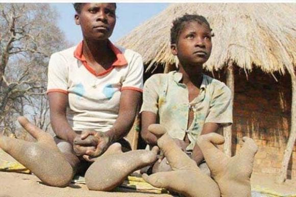 Bộ lạc châu Phi có bàn chân 'đà điểu': Tại sao mỗi bàn chân chỉ có hai ngón?