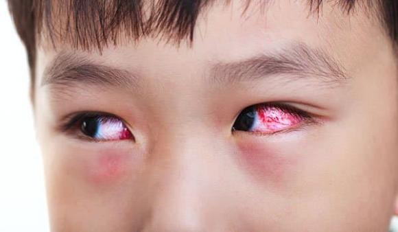 đau mắt đỏ, dịch đau mắt đỏ, sức khỏe 