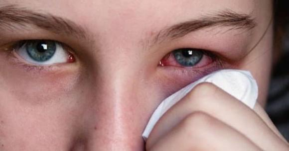 đau mắt đỏ, kiêng chuyện giường chiếu, phòng tránh đau mắt đỏ