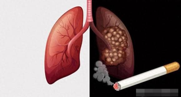 hút thuốc, thuốc lá, ung thư  phổi