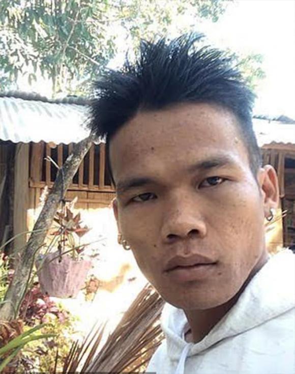 con dao mắc kẹt trong người đàn ông Philippines, bác sĩ địa phương thất trách