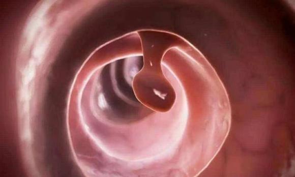 Polyp ruột, Polyp 