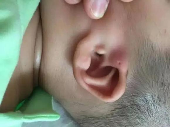 lỗ rò tai, lỗ nhỏ ở tai