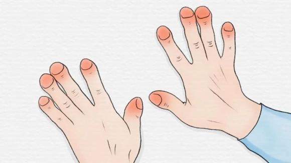 ung thư, dấu hiệu ung thư, dấu hiệu ung thư qua chân tay