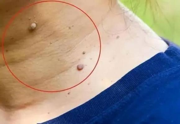 mụn thịt, chăm sóc sức khỏe, da có mụn thịt
